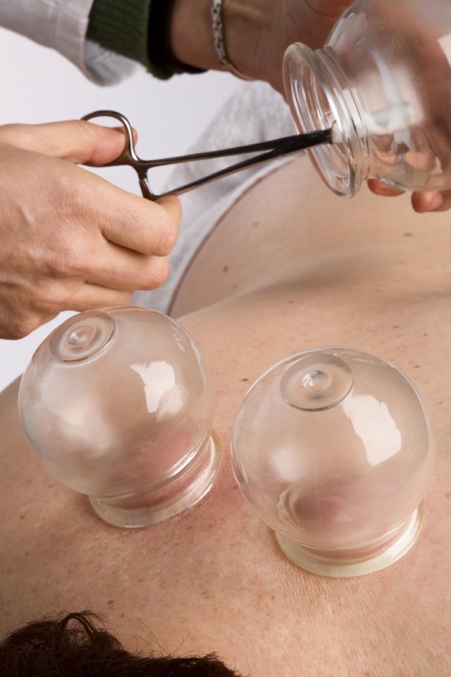 What’s Cupping ?